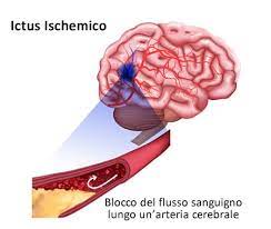 Ictus ischemico